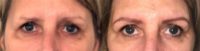 45-54 year old woman treated with Microblading