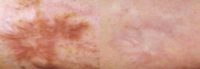 55-64 year old man treated with Scar Removal