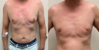 35-44 year old man treated with Skin Tightening