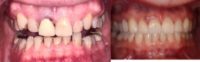 65-74 year old man treated with Smile Makeover
