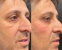 45-54 year old man treated with Injectable Fillers