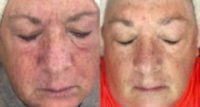 55-64 year old woman treated with DefenAge