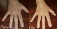 Hand Restoration with Radiesse