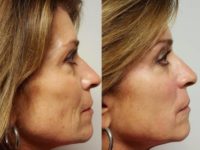 Instant Face Lift and Smile Lines Gone with Bellafill