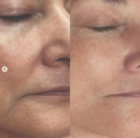 Woman treated with Microneedling