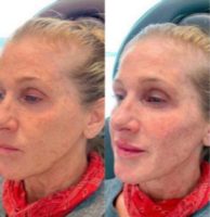 Woman treated with Cheek Fillers