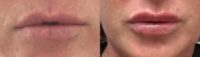 Woman treated with Lip Fillers, Restylane, Restylane Kysse